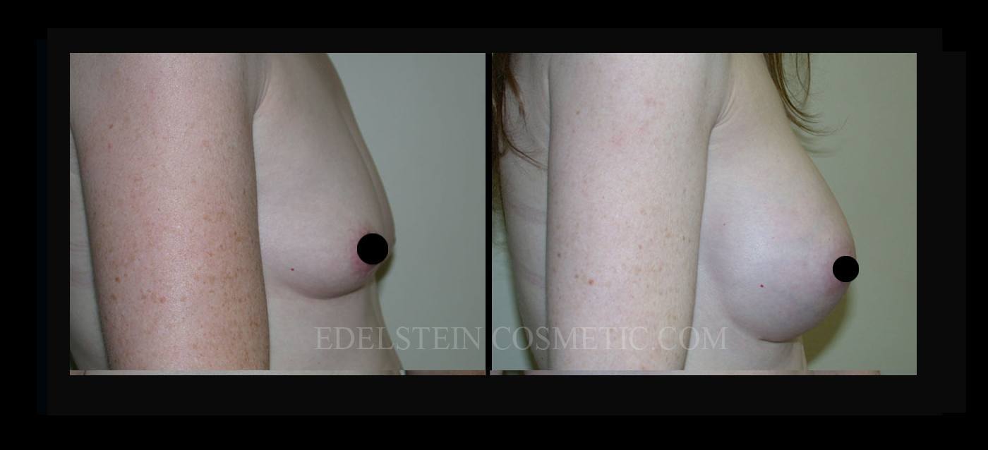 Breast Augmentation case #26731