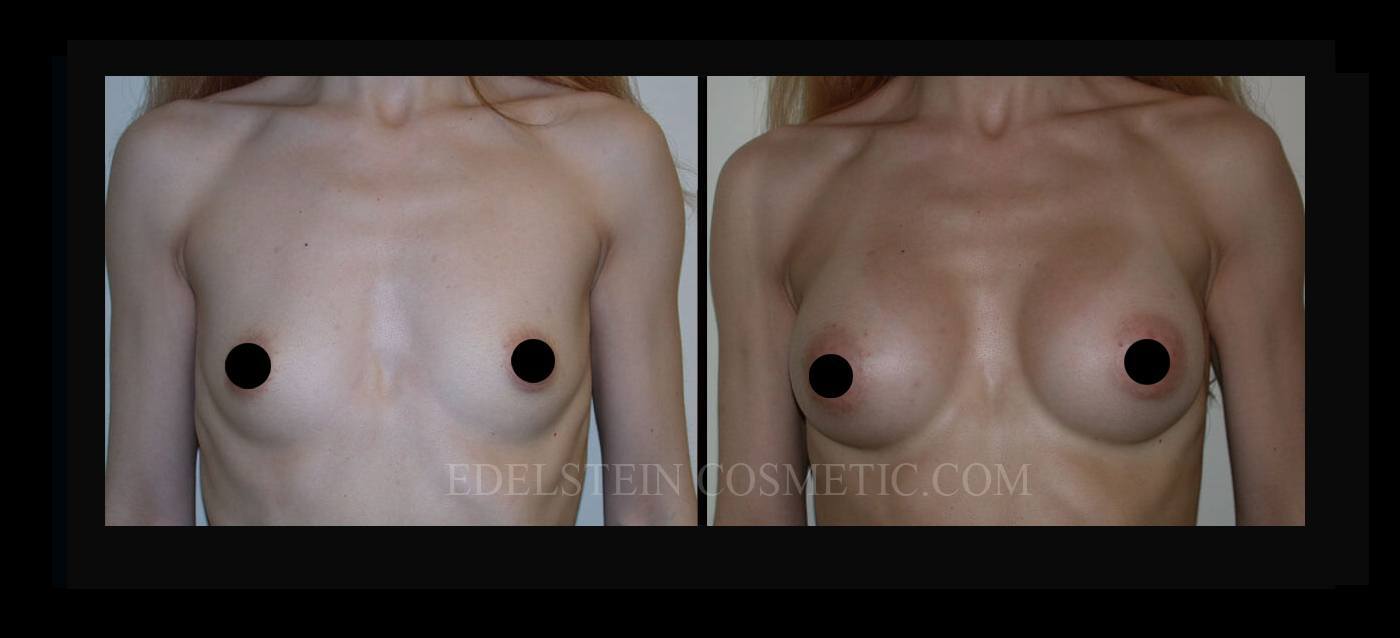 Breast Augmentation case #26729