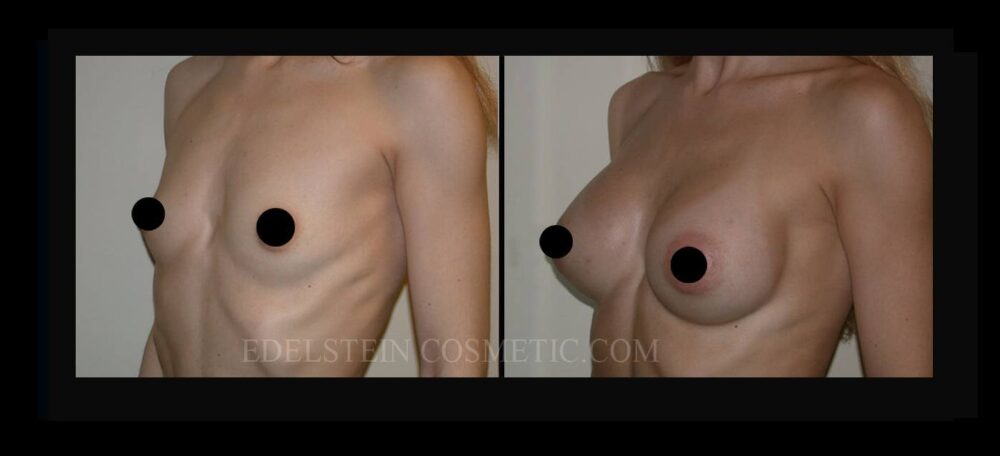 Breast Augmentation case #26729