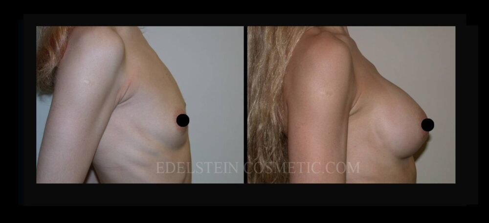 Breast Augmentation case #26729