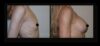 Breast Augmentation case #26729 slider thumbnail