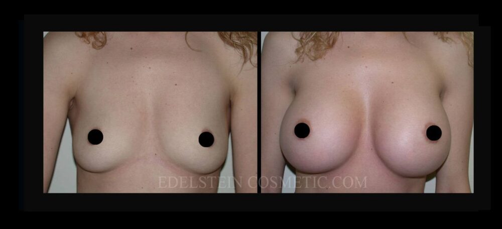 Breast Augmentation case #26727