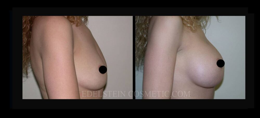 Breast Augmentation case #26727