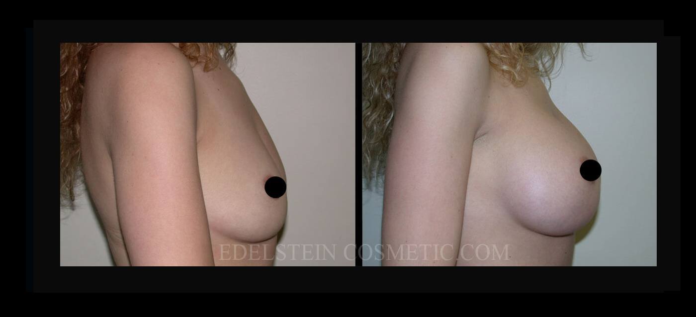 Breast Augmentation case #26727