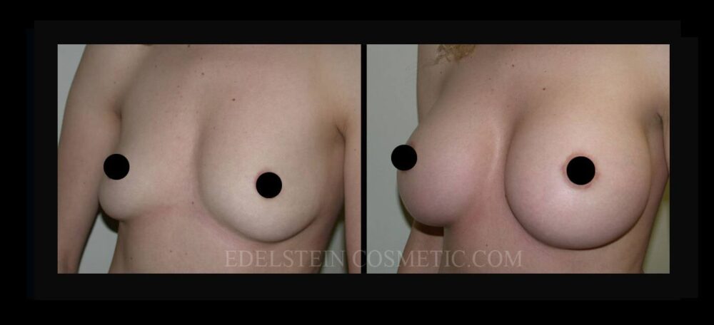 Breast Augmentation case #26727