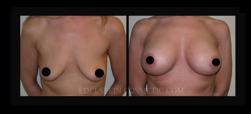 Breast Augmentation case #26726