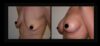 Breast Augmentation case #26726 slider thumbnail