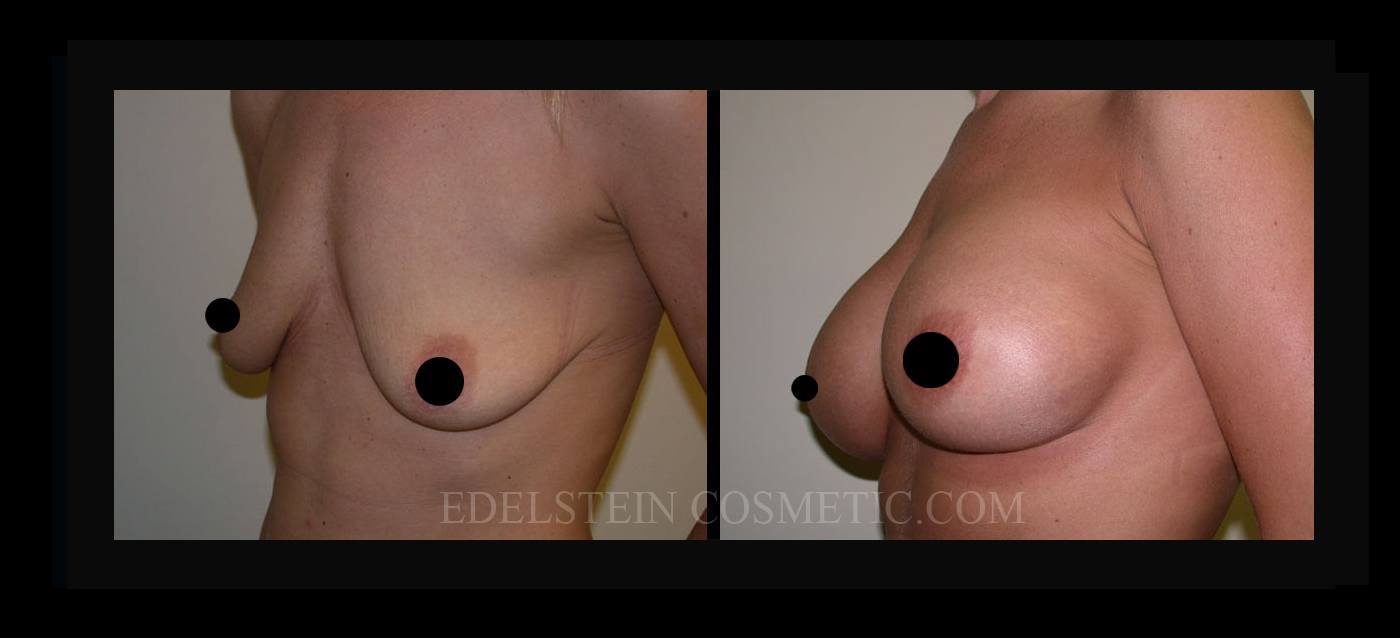 Breast Augmentation case #26726