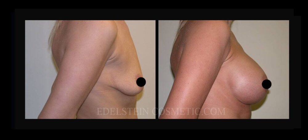 Breast Augmentation case #26726