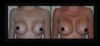 Breast Augmentation case #26725 slider thumbnail