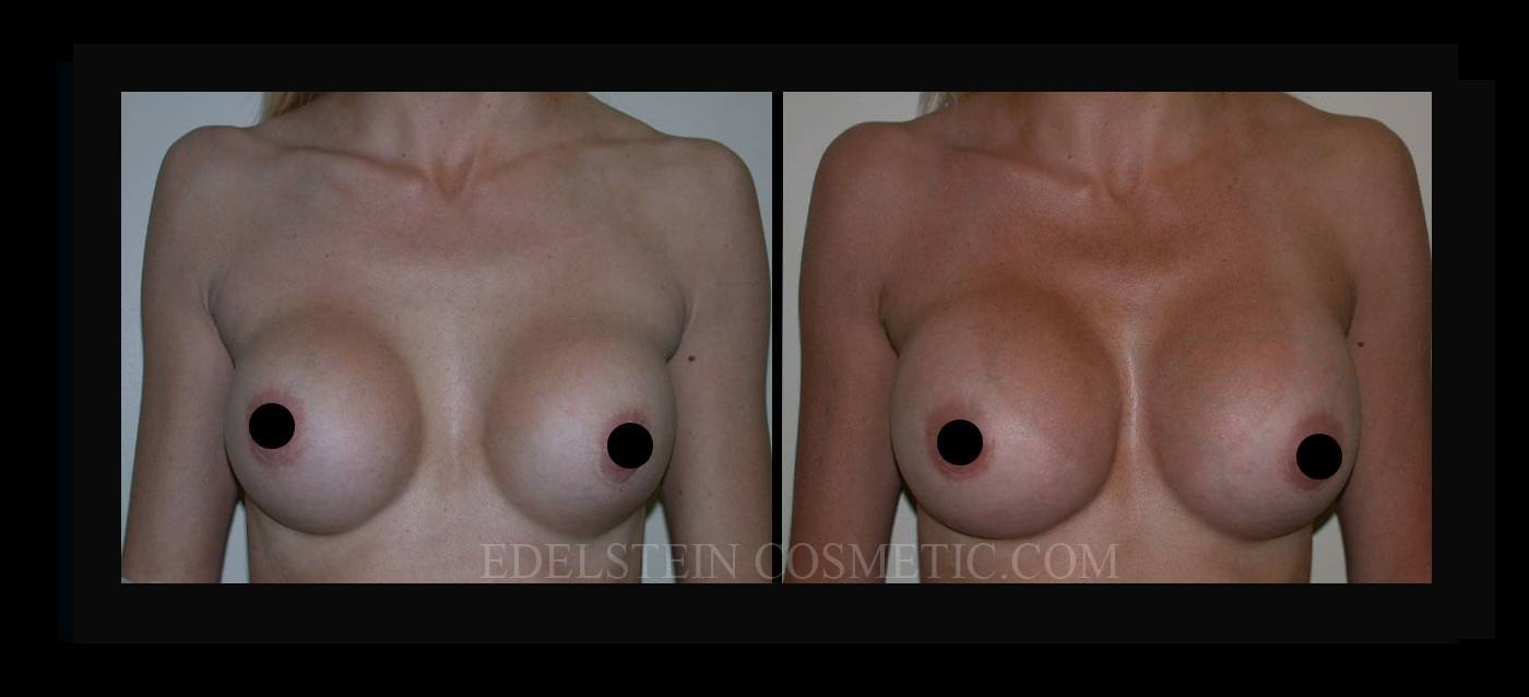 Breast Augmentation case #26725
