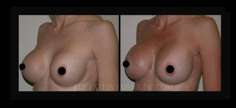 Breast Augmentation case #26725