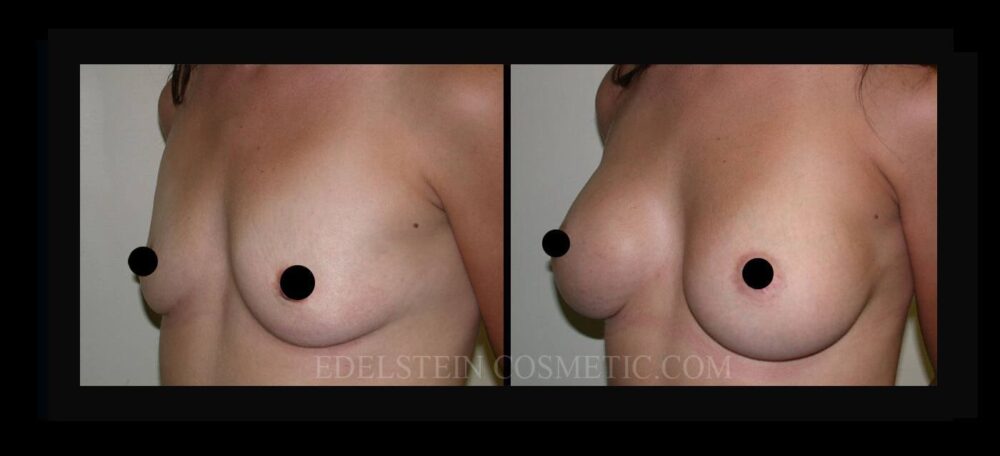 Breast Augmentation case #26724