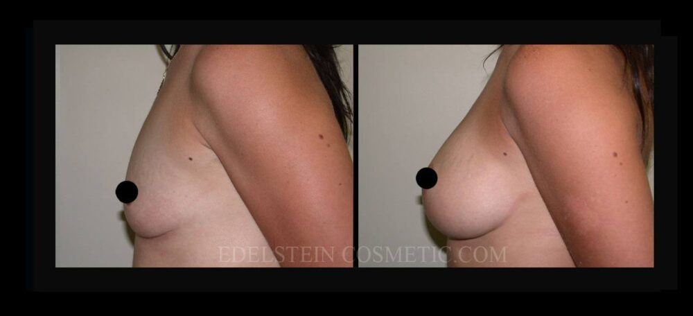 Breast Augmentation case #26724