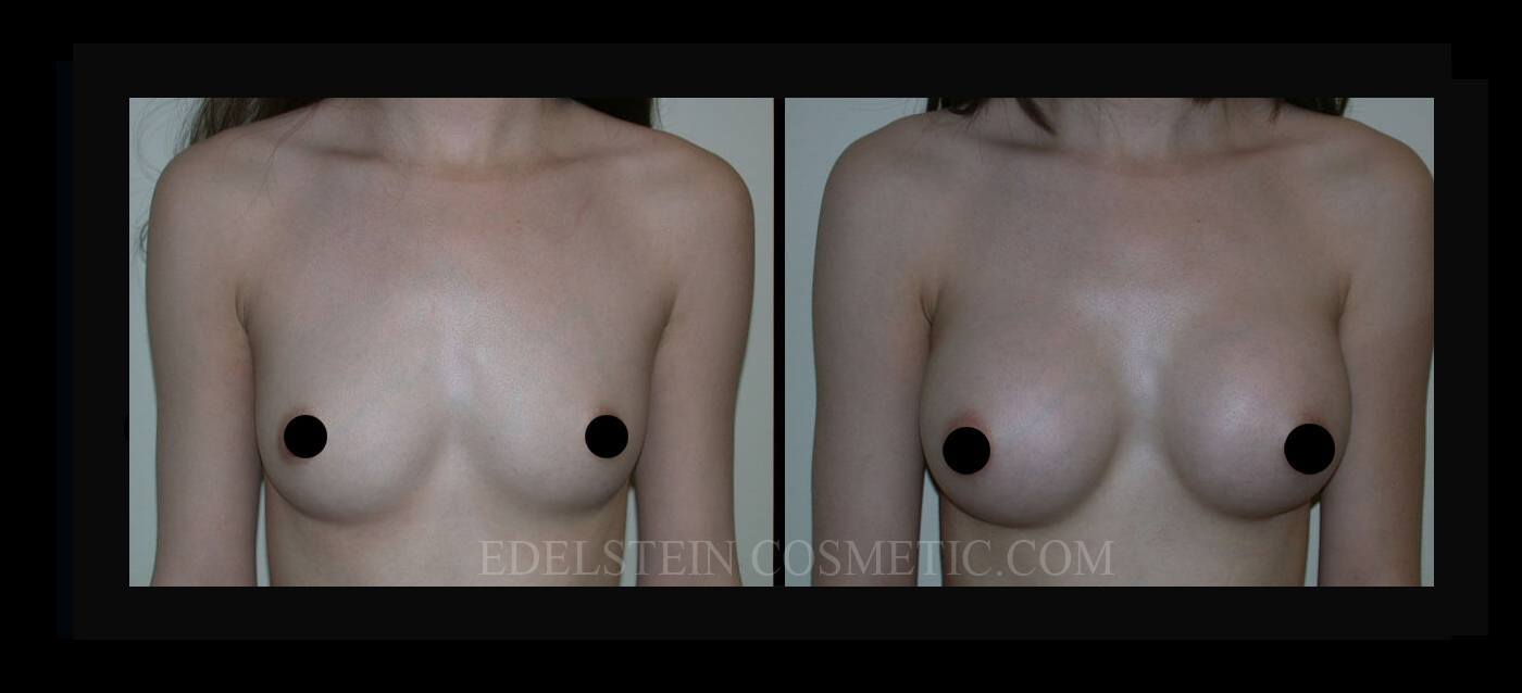 Breast Augmentation case #26723