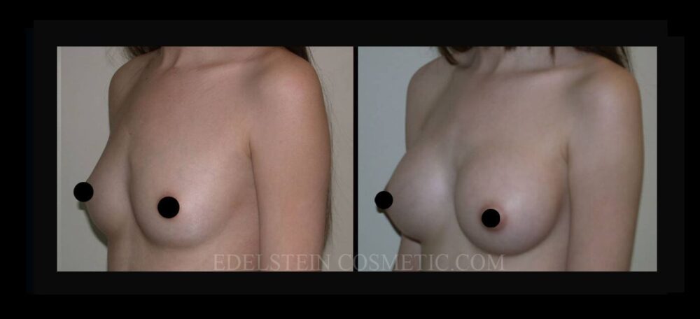 Breast Augmentation case #26723