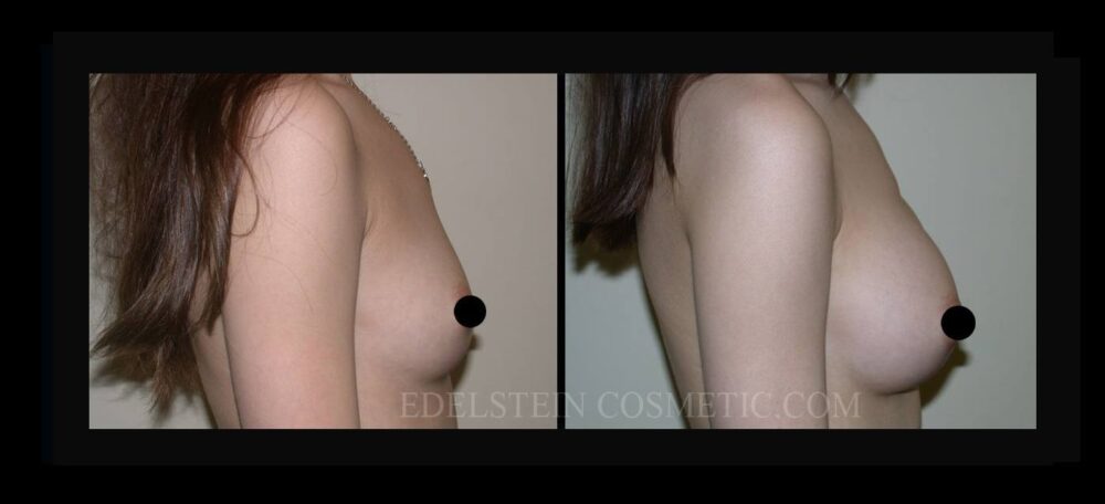 Breast Augmentation case #26723