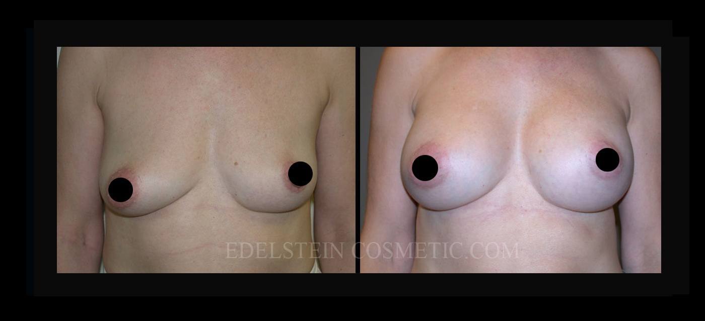 Breast Augmentation case #26722