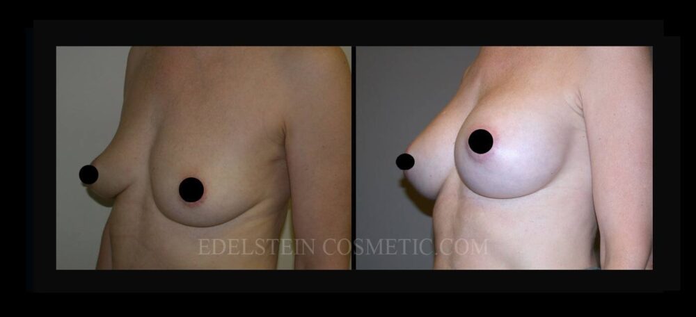 Breast Augmentation case #26722