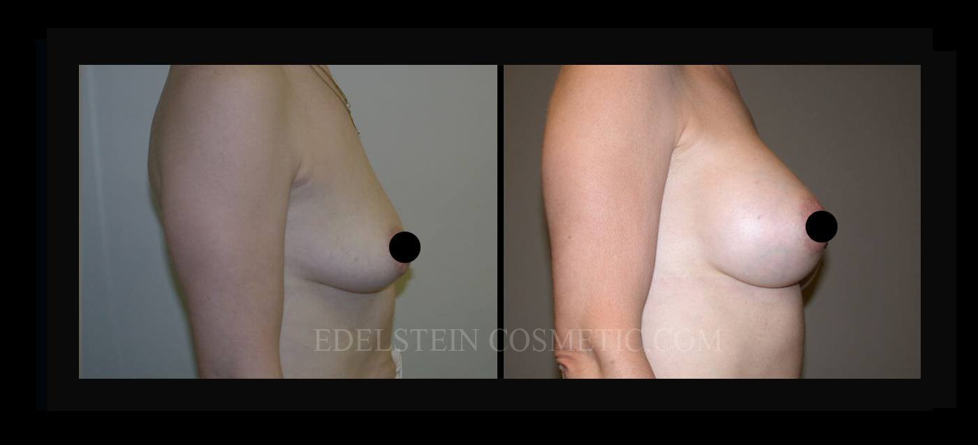 Breast Augmentation case #26722