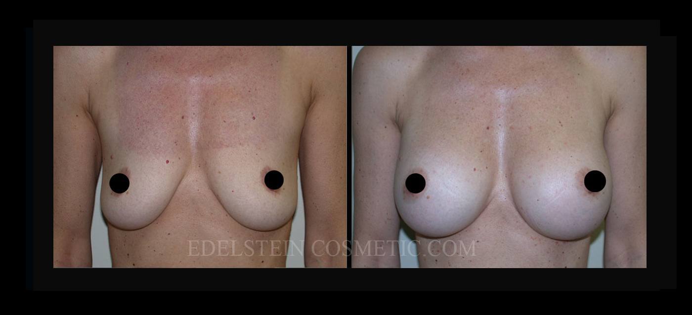 Breast Augmentation case #26720