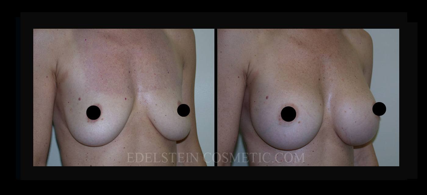 Breast Augmentation case #26720