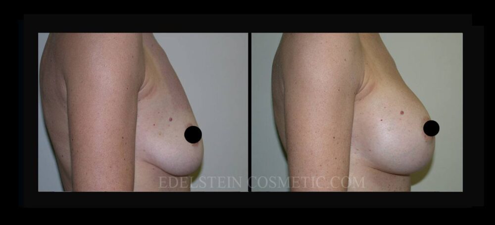 Breast Augmentation case #26720