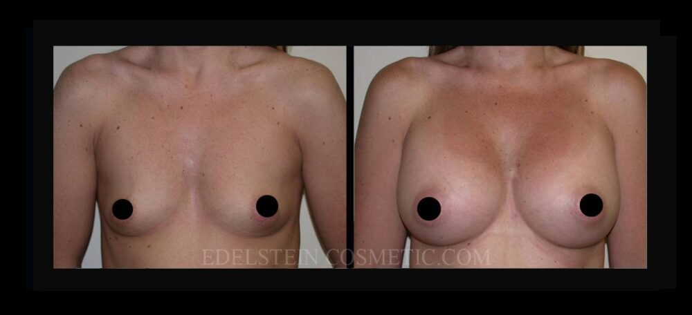 Breast Augmentation case #26717