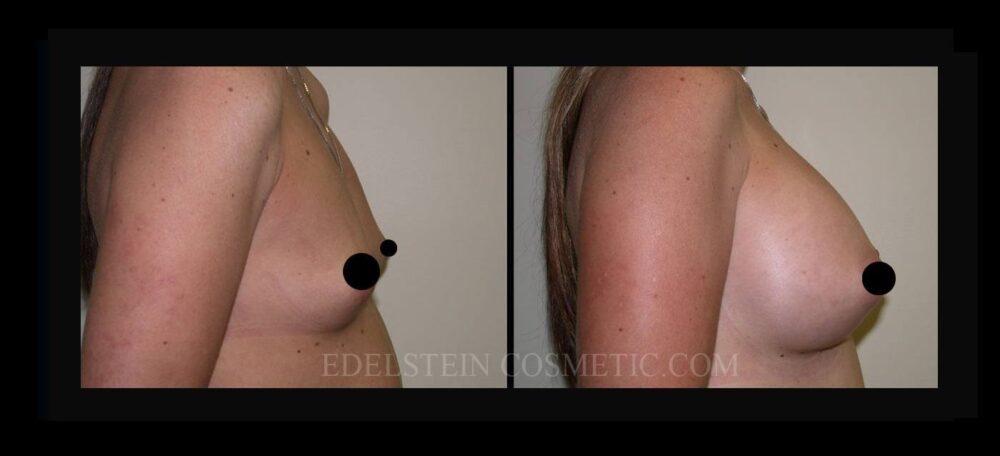 Breast Augmentation case #26717