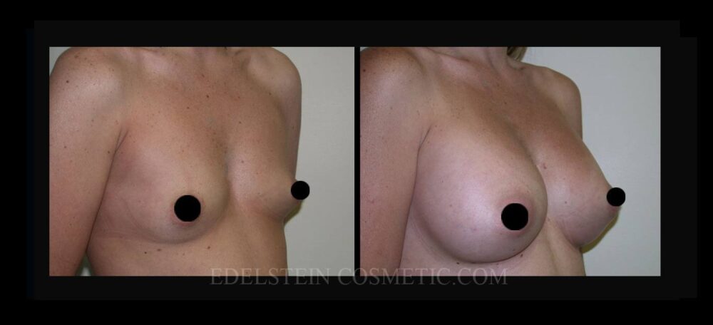 Breast Augmentation case #26717