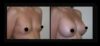 Breast Augmentation case #26717 slider thumbnail