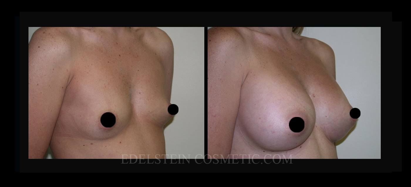 Breast Augmentation case #26717