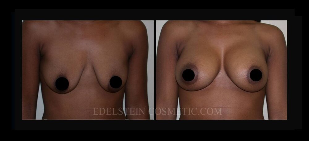 Breast Augmentation case #26714