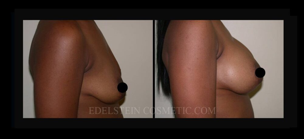 Breast Augmentation case #26714