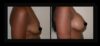 Breast Augmentation case #26715 slider thumbnail