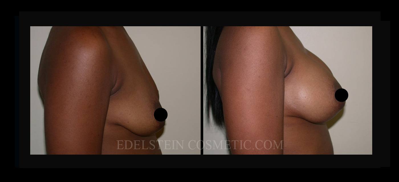 Breast Augmentation case #26715