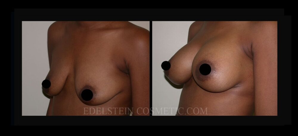 Breast Augmentation case #26714