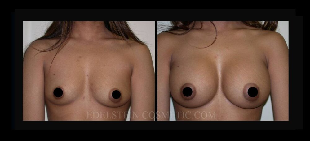 Breast Augmentation case #26712