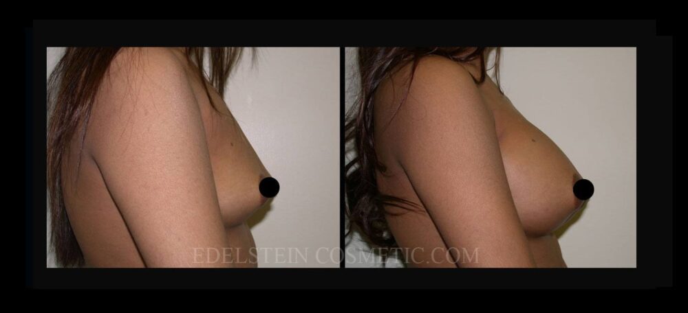 Breast Augmentation case #26712