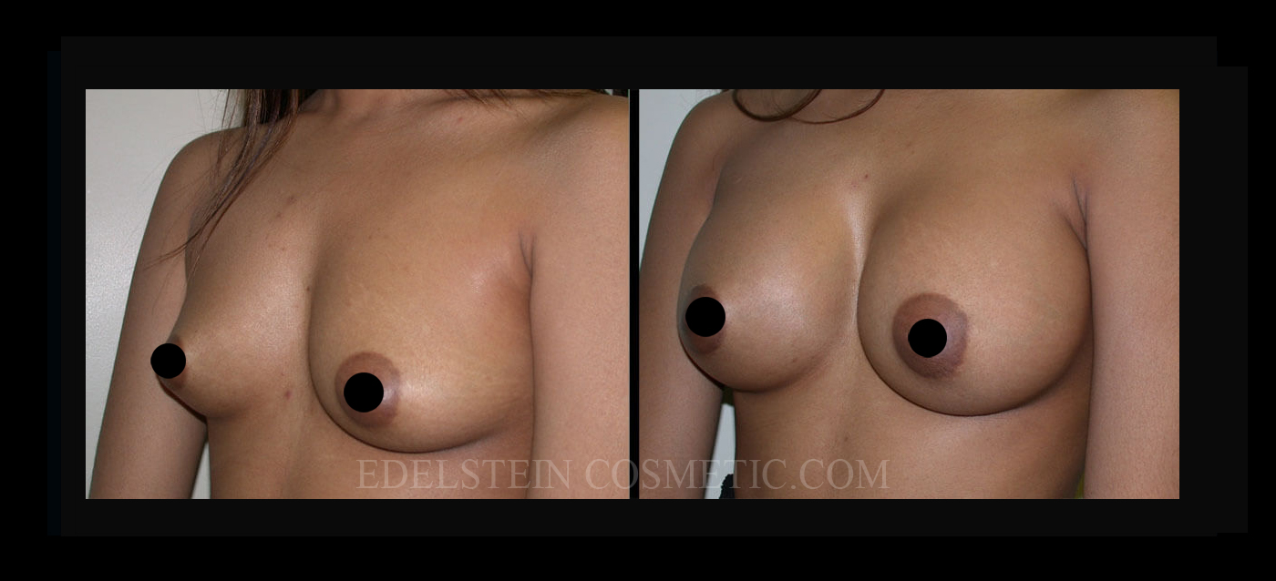 Breast Augmentation case #26712