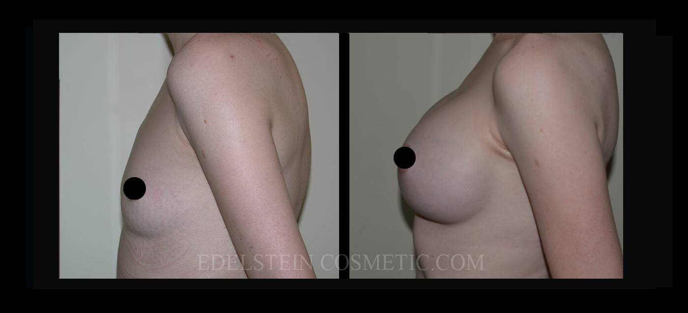 Breast Augmentation case #26702