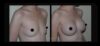 Breast Augmentation case #26702 slider thumbnail