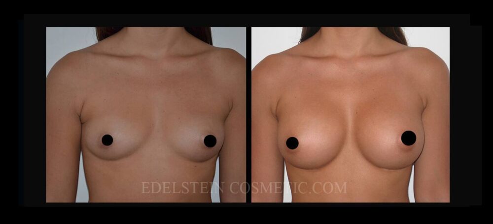 Breast Augmentation case #26700