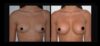 Breast Augmentation case #26700 slider thumbnail