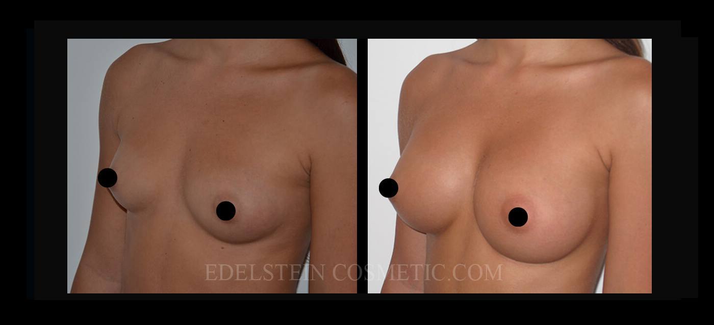 Breast Augmentation case #26700