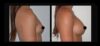 Breast Augmentation case #26700 slider thumbnail