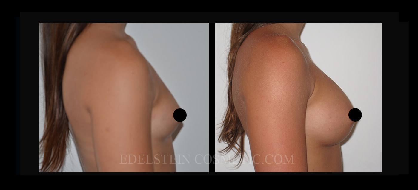 Breast Augmentation case #26700