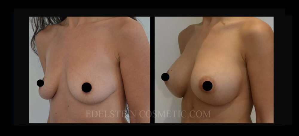 Breast Augmentation case #26697