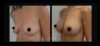 Breast Augmentation case #26697 slider thumbnail