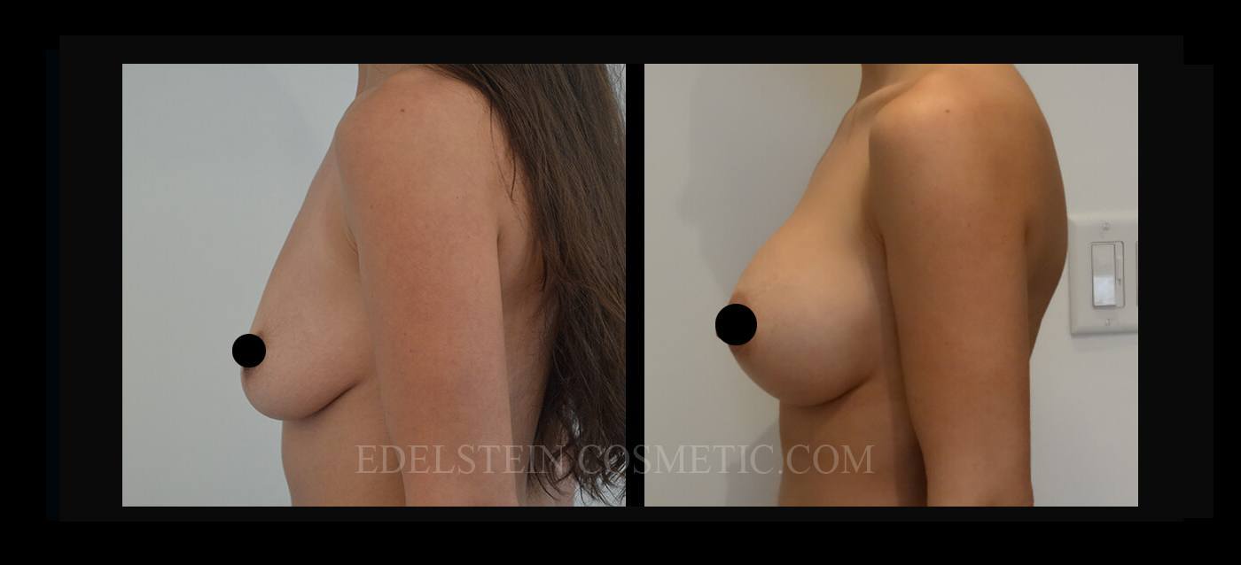 Breast Augmentation case #26697